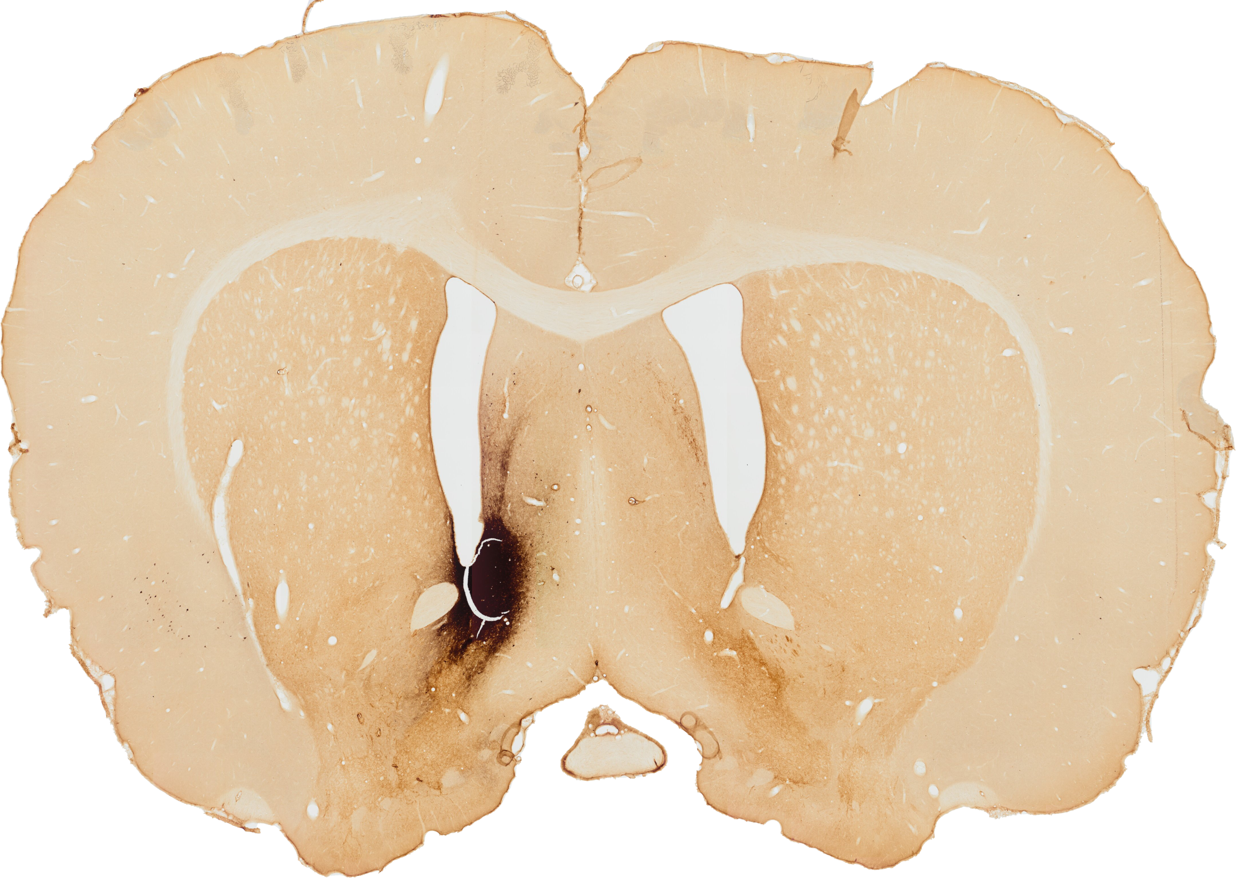 Nucleus Accumbens injection side